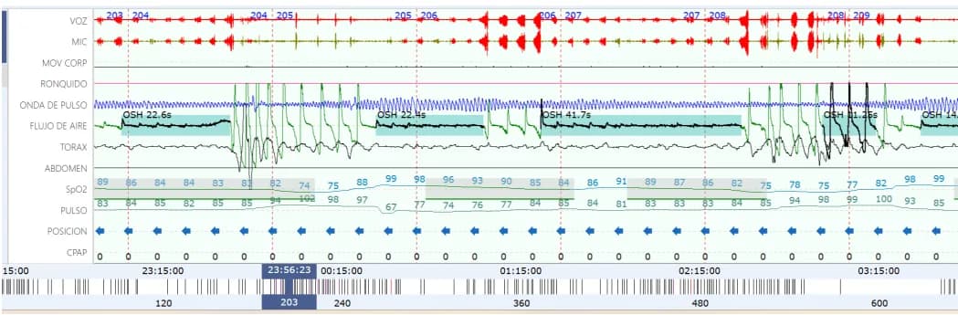 Gráfico de poligrafía mostrando evento de apnea y desaturación